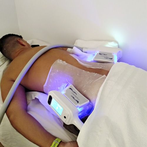 Hombre con tratamiento de criolipolisis en cintura