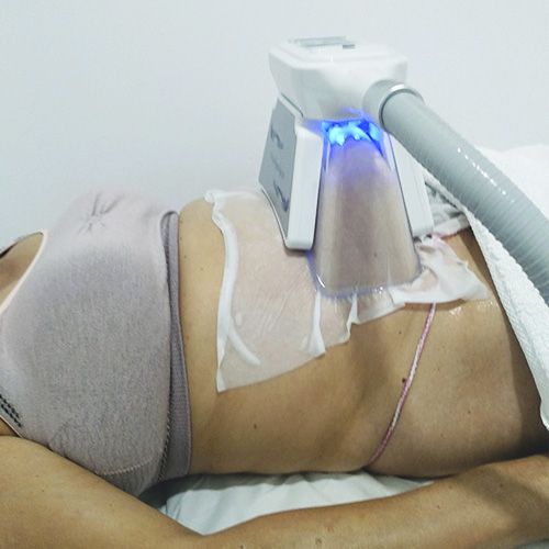 Mujer con tratamiento de criolipolisis en barriga