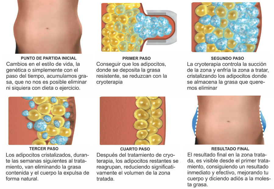 Fases de la criolipólisis y cómo funciona