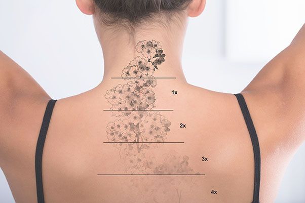 Eliminar tatuaje en espalda en Mairena del Aljarafe, Sevilla