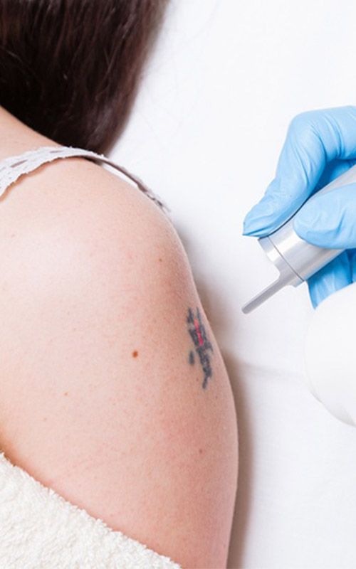 Quitar tatuaje en el brazo con láser en el Aljarafe, Sevilla